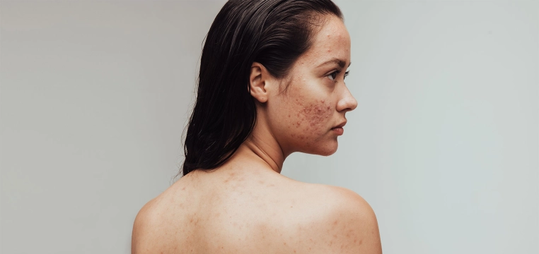 Femme avec acné